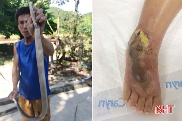 Rắn độc chui dưới gầm ghế, cắn bé gái 2 tuổi ở Hà Tĩnh bị hoại tử chân