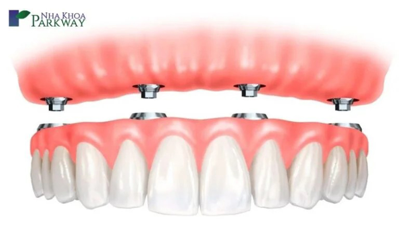 Quy trình trồng răng implant mất bao lâu tại Parkway
